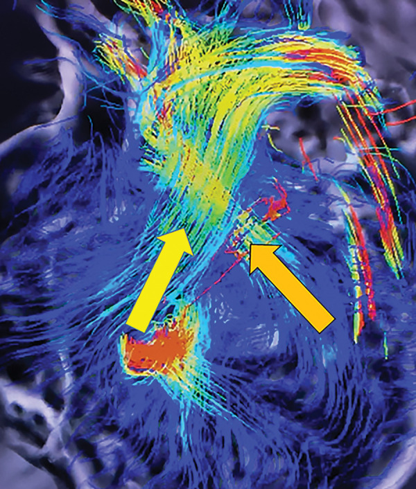 Still image capture from four-dimensional flow MRI movie file shows the right ventricular outflow track (yellow arrow) and the left ventricular outflow track (orange arrow).