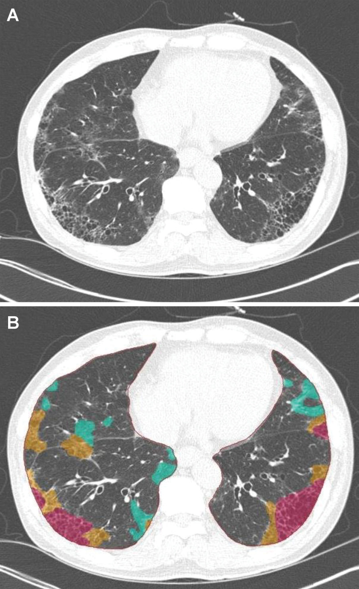 Artificial intelligence–based automatic quantification of regional disease pattern on CT images. A, The original image and, B, parametric map of thin-section CT of interstitial lung disease show that deep learning–based automatic quantification of local disease pattern is possible. Red on the parametric map represents the areas of honeycombing; yellow, reticulation; and green, ground-glass opacity.