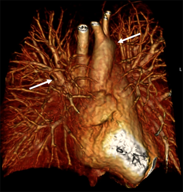 Raw perfusion coronal MRI scan from a movie by using the differential subsampling with Cartesian ordering technique (water images) after the bolus administration of contrast material (Multihance; Bracco) shows the dextrophase and levophase of cardiovascular, pulmonary, and great vessel contrast enhancement (arrows).