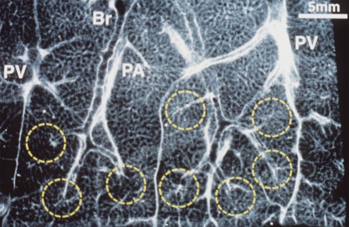 Anatomic basis for understanding pulmonary functional physiologic structure. (a) Magnified view of alveolar ducts and alveoli with orifices in a healthy patient. Alveoli are polygonal in shape and have orifices into alveolar ductal spaces. (b) Histologic sample of the healthy lung with hematoxylin-eosin stain. The divergence from terminal to respiratory bronchioles is shown. (c, d) A radiograph of 1-mm-thick specimen demonstrates the secondary lobules. The pulmonary arteries are located in the center, and pulmonary veins are located in the periphery of the secondary pulmonary lobule. The terminal and respiratory bronchioles are observed as tubular structures accompanying the pulmonary arteries. The primary lobules are indicated as yellow dashed circles in d. (Parts a–d adapted, with permission, from reference 10.) (e) Diagram shows anatomy and dimensions of secondary lobule and pulmonary acinus. Two secondary pulmonary lobules in the lung periphery are illustrated, with approximate dimensions of their components indicated. (Reprinted, with permission, from reference 12.)