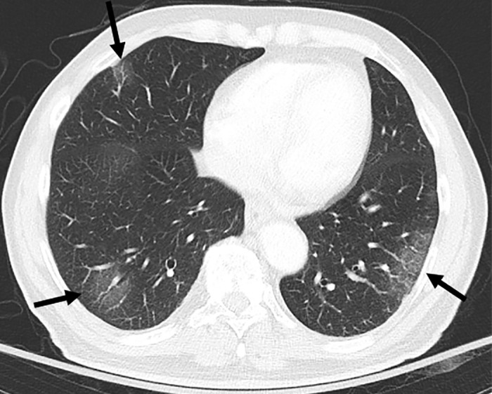 CT scan in lower lung areas in an 83-year-old male patient with coronavirus disease 2019 pneumonia and severe hypoxemia. Bilateral multifocal patchy ground-glass opacities with peripheral distribution are visible (arrows).