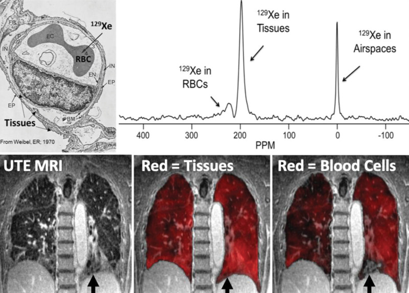 Demonstration of gas diffusion block in interstitial lung disease. Xenon 129 (129Xe) gas is soluble in the tissue and plasma and red blood cells (RBCs) from the alveolar airspace into the tissue-capillary interface. This results in measurable chemical shifts for the tissue and plasma and red blood cell compartments approximately 200 ppm downfield from the gas resonance (upper right). Spectroscopic imaging can be fused with anatomic ultrashort echo time (UTE) images (lower left) in fibrotic lung disease to demonstrate diffusion block in which the tissues and plasma take up the 129Xe homogeneously (lower middle), but red blood cell uptake is heterogeneous (lower right) or not present (lower row arrows) in a region of apparent honeycombing. (Upper left image used with permission from reference 111).