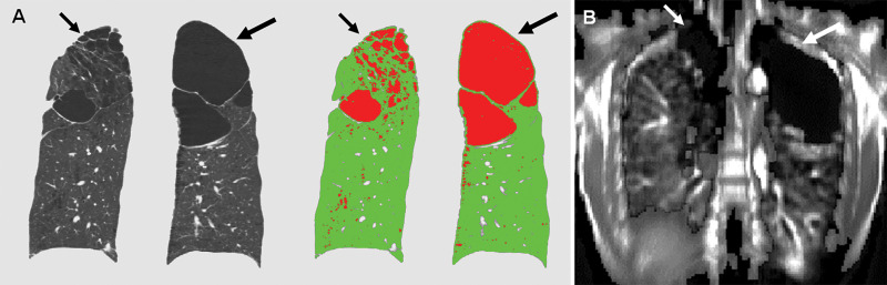 Pulmonary Functional Imaging: Part 1—State-of-the-Art Technical and ...