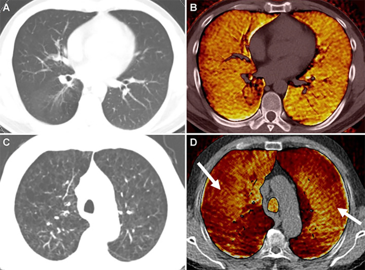 Xenon (Xe) ventilation dual-energy CT in patients with, A, B, chronic obstructive pulmonary disease and mild emphysema and with, C, D, moderate to severe emphysema. A, Dual-energy CT image shows minimal centrilobular emphysema in right lower lobe on axial weighted average image and, B, homogeneous Xe enhancement on Xe ventilation map in both lungs. C, Axial weighted average image shows severe emphysema with bronchial wall thickening in both upper lobes. D, On Xe ventilation map, the inhomogeneously decreased Xe enhancement is identified in both upper lobes, whereas Xe ventilation is relatively preserved in the central areas of both upper lobes (arrows).