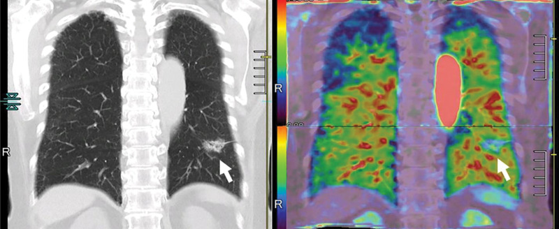 Images in a 73-year-old male patient with invasive adenocarcinoma (arrows) in the left lower lobe. Thin-section coronal multiplanar reconstruction image and quantitatively assessed whole-lung perfusion CT image (left) displayed as total perfusion map (right; combination of pulmonary arterial blood supply and systemic arterial blood supply from bronchial artery). Invasive adenocarcinoma (arrows) appears as part-solid nodule and decreased perfusion area compared with normal lungs. In addition, solid component shows relatively higher perfusion than ground-glass opacity. Whole-lung perfusion map was generated from two dynamic contrast-enhanced area-detector CT data sets by using our proprietary software.