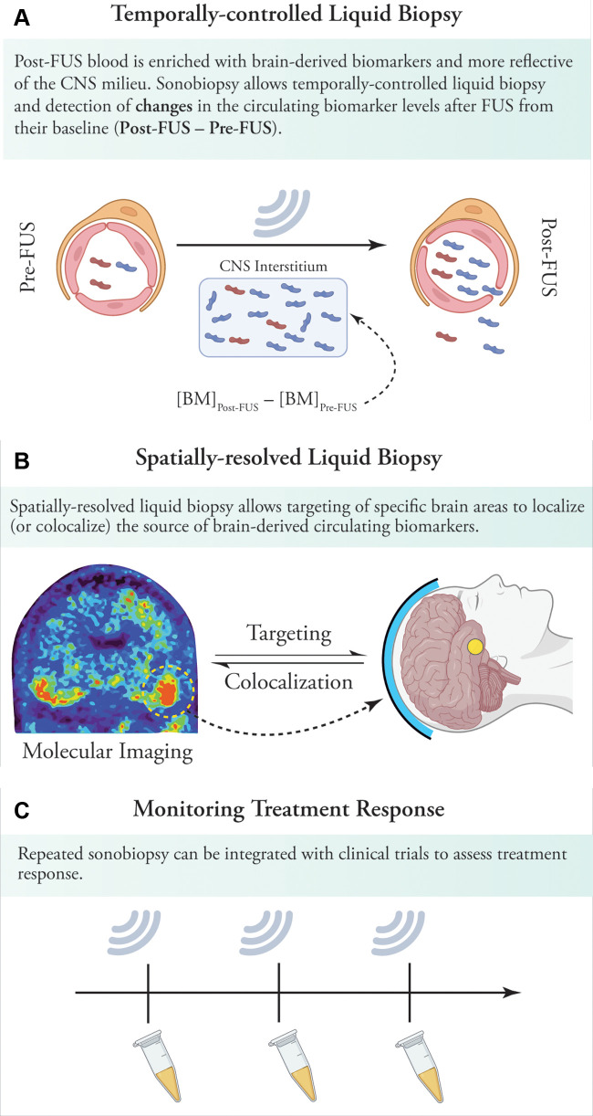 Implications of sonobiopsy in clinical settings. (A) By opening the blood-brain barrier (BBB) and releasing proteins from the brain into the circulation, sonobiopsy can enrich plasma with brain-derived pathologic protein species. By simply collecting blood samples before and after sonications, sonobiopsy enables temporally controlled liquid biopsy and detection of changes in circulating pathologic protein species and other biomarkers after focused ultrasound. (B) Sonobiopsy can allow spatially resolved liquid biopsy. This can, in turn, be used for targeted BBB opening in brain areas with high protein deposits on molecular imaging (eg, tau or amyloid PET imaging). Sonobiopsy of these brain areas could shed light on the dominant pathogenic subtypes in heavily involved brain areas. In addition, the release of abnormal specific protein species can be colocalized to the brain regions showing the greatest metabolic, structural, or microstructural deficits. This can help identify the main culprits in pathogenesis of various neurodegenerative disorders. (C) Sonobiopsy can be readily integrated into focused ultrasound–induced BBB opening clinical trials to allow monitoring of treatment response by assessing changes in brain-derived pathogenic proteins. BBB = blood-brain barrier, BM = biomarker concentration in plasma, CNS = central nervous system, FUS = focused ultrasound.