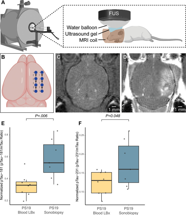 MRI-guided sonobiopsy changed composition of circulating phosphorylated tau (p-tau) species in 2-month-old PS19 mice (experiment 1). (A) Diagram of the focused ultrasound (FUS) system in the small-animal MRI scanner. The mouse head was fixed in the MRI coil, and the focused ultrasound transducer was coupled to the skull with ultrasound gel and a water balloon filled with degassed water. (B) Schematic of the focused ultrasound trajectory targeting the right cerebral hemisphere. (C) T1-weighted MRI scans were acquired before focused ultrasound and intravenous contrast material administration. (D) Post-focused ultrasound/postcontrast T1-weighted MRI scans confirmed focused ultrasound–induced blood-brain barrier (BBB) disruption as a signal enhancement. Except for one wild-type mouse, successful BBB opening was observed in all mice that underwent focused ultrasound (six of seven wild-type mice, seven of seven PS19 mice). The wild-type mouse with no evidence of BBB opening after focused ultrasound was excluded from further analysis. There was no significant group difference (P = .71) in the volume of focused ultrasound–mediated BBB opening between PS19 (mean, 30.88 mm3 ± 17.94 [SD]) and wild-type (35.12 mm3 ± 22.94) mice. (E) In PS19 mice, normalized p-tau-181 (p-tau-181–to–m-tau ratio) was significantly greater (P = .006) in the sonobiopsy group (n = 7; mean, 0.57 ± 0.19) compared with the normalized pTau-181 in the blood-based liquid biopsy (blood LBx) group (ie, control group without focused ultrasound treatment; n = 8; mean, 0.36 ± 0.09). (F) In PS19 mice, the normalized pTau-231 (pTau-231–to–m-tau ratio) was significantly greater (P = .048) in the sonobiopsy group (n = 8; mean, 0.17 ± 0.06) compared with the normalized pTau-181 in the blood LBx group (n = 7; mean, 0.13 ± 0.03). Black bars indicate median in E and F.