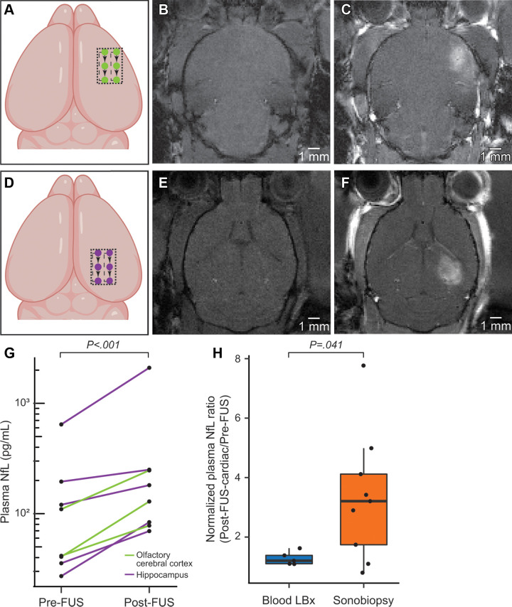 Sonobiopsy enhanced levels of plasma neurofilament light chain protein (NfL) in 6-month-old PS19 mice (experiment 2). (A) Schematic of the focused ultrasound trajectory targeting the olfactory cerebral cortex (piriform cortex and amygdala). (B) T1-weighted MRI scans were acquired before focused ultrasound and intravenous contrast material administration. (C) Post-focused ultrasound and postcontrast T1-weighted MRI scans enabled confirmation of focused ultrasound-induced blood-brain barrier (BBB) disruption as a signal enhancement. (D) Schematic of the focused ultrasound trajectory targeting the hippocampus. (E) T1-weighted MRI scans were acquired before focused ultrasound and intravenous contrast material administration. (F) Post-focused ultrasound and postcontrast T1-weighted MRI scans enabled confirmation of focused ultrasound–induced BBB disruption as a signal enhancement. There was no significant difference (P = .17) in the volume of focused ultrasound–mediated BBB disruption between mice treated at the olfactory cerebral cortex (mean, 21.74 mm3 ± 5.81) or the hippocampus (mean, 15.42 mm3 ± 5.83). (G) Sonobiopsy resulted in a 2.3-fold increase in plasma NfL levels (n = 8, P < .001). (H) The normalized plasma NfL (post-focused ultrasound–to–pre-focused ultrasound ratio) was significantly greater (P = .041) in the sonobiopsy group (n = 9, 3.34 ± 2.15) than the blood LBx group (control group without focused ultrasound treatment, n = 5; 1.28 ± 0.22). Black bar indicates median.