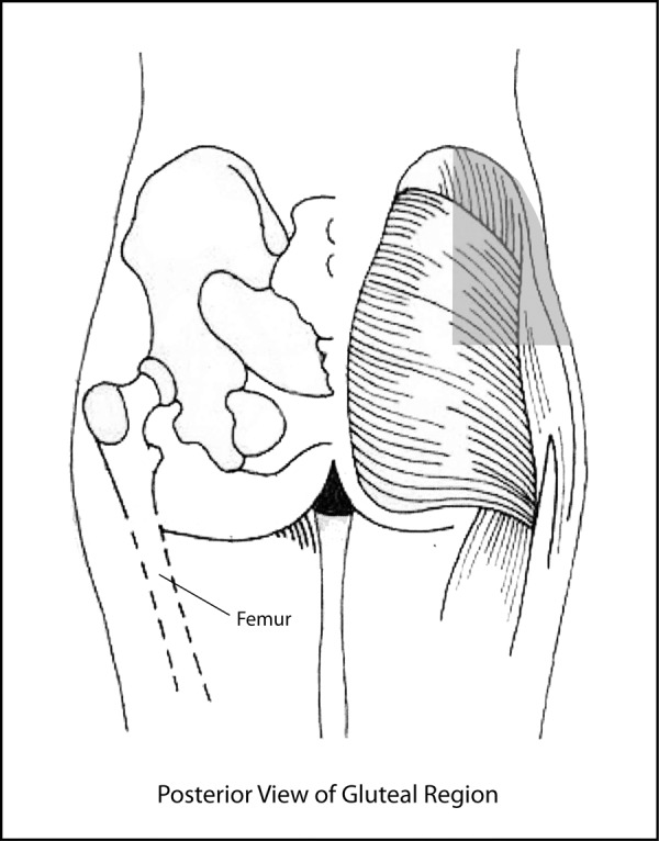 Are nursing students safe when choosing gluteal intramuscular injection ...