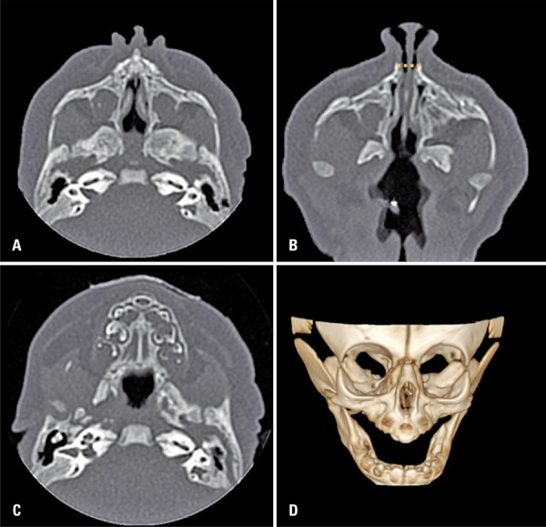 Congenital nasal pyriform aperture stenosis with single central ...