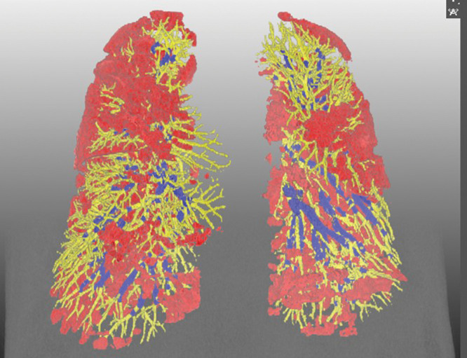 Representative three-dimensional chest CT image in a 52-year-old man with the Omicron variant of COVID-19 shows pneumonia evenly affecting lungs (pneumonia volume, 17.5%) and a preserved percentage of blood volume in intrapulmonary vessels, with a cross-sectional area less than 5 mm2 relative to the total pulmonary blood volume (51.5%). Blue vessels have a cross-sectional area of 5 mm2 or greater, and yellow vessels have a cross-sectional area less than 5 mm2. Red indicates COVID-19 pneumonia.