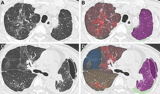 Chest CT images in a 77-year-old man with the Omicron variant of COVID-19 with indeterminate CT appearance. (A, C) Unenhanced axial CT images show unilateral peribronchovascular ground-glass opacities without intralobular lines or an apicobasal predilection. (B, D) Segmentation overlay images show the segmentation results of pneumonia (red), lobes (orange to violet), effusion (light green), and pulmonary vessels with a cross-sectional area less than 5 mm2 (yellow) and 5 mm2 or greater (blue). The visual CT score was 13 points, and the pneumonia volume was 8%. A focal ground-glass opacity in the lateral portion of D was not included in the pneumonia mask because it was the minor fissure between the right upper and middle lobes.