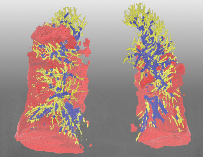 Representative three-dimensional chest CT image in an 88-year-old woman with the Delta variant of COVID-19 shows lower-lobe–predominant pneumonia (pneumonia volume, 14.7%) and a lower percentage of blood volume in intrapulmonary vessels, with a cross-sectional area less than 5 mm2 relative to the total pulmonary blood volume (34.6%). Blue vessels have a cross-sectional area of 5 mm2 or greater, and yellow vessels have a cross-sectional area less than 5 mm2. Red indicates COVID-19 pneumonia.