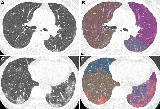 Chest CT images in a 66-year-old woman with the Delta variant of COVID-19 with a typical CT appearance. (A, C) Unenhanced axial CT images show peripheral bilateral ground-glass opacities with some intralobular lines predominantly involving both lower lobes. (B, D) Segmentation overlay images show the segmentation results of pneumonia (red), lobes (orange to violet), and pulmonary vessels, with a cross-sectional area less than 5 mm2 (yellow) or 5 mm2 or greater (blue). The visual CT score was 12 points, and the pneumonia volume was 9%.