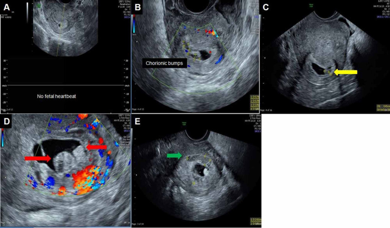 Chorionic Bump Radiologic Features And Pregnancy Outcomes Pmc