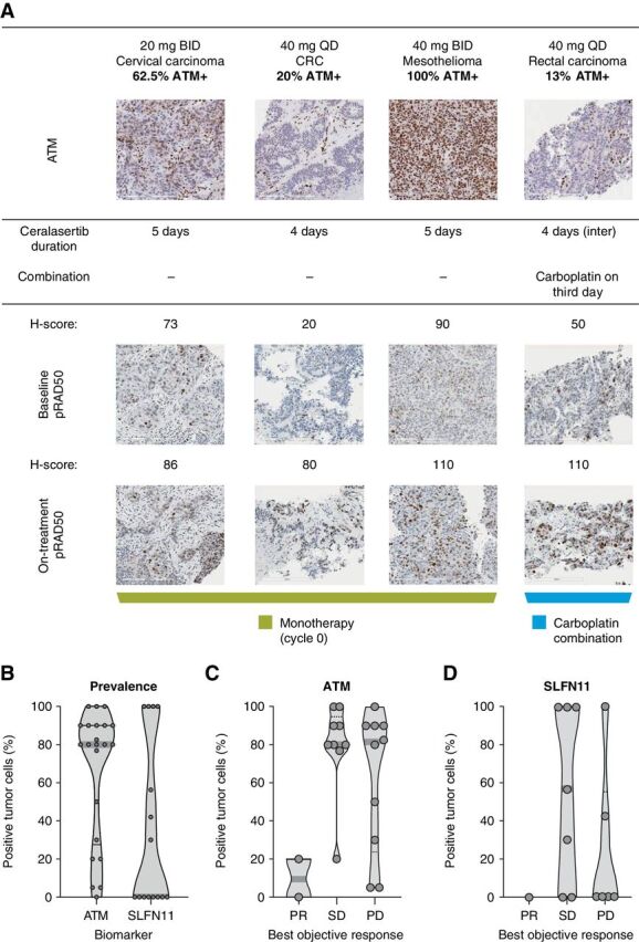 Figure 4. A, Analysis of pRAD50 in paired tumor biopsies. B, Prevalence of ATM and SLFN11 in archival tumor samples. C, Correlation of ATM tumor expression with best objective response. D, Correlation of SLFN11 tumor expression with best objective response. A, top, total ATM expression at baseline. Tumors were scored by percentage of tumor nuclei positive. Previous studies have shown that in ATM-expressing tumors, induction of pRAD50 is a marker of ATR inhibition. Importantly, in each of the tumors for which paired biopsies were collected, ATM expression was documented at baseline. Bottom, Induction of pRAD50 by H-score on treatment compared with baseline. All paired biopsies demonstrated induction of pRAD50 consistent with inhibition of ATR. B, Each point represents the percentage positive tumor cells in an individual tumor. C and D, Each point represents an individual patient.