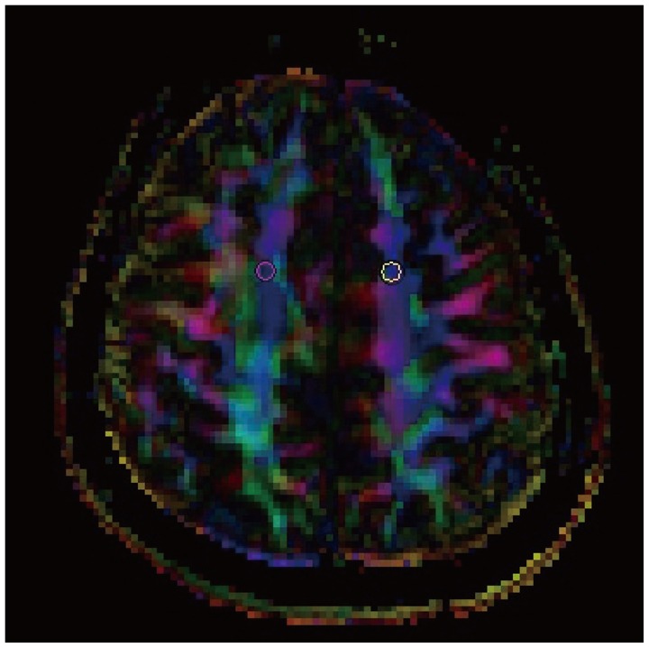 Microstructural Changes of Anterior Corona Radiata in Bipolar ...