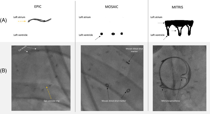 Comparative differences of mitral valve‐in‐valve implantation: A new ...