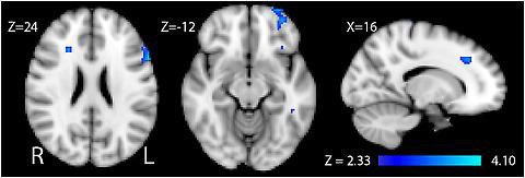 graphic file with name cerebrum-10-11-g001.jpg