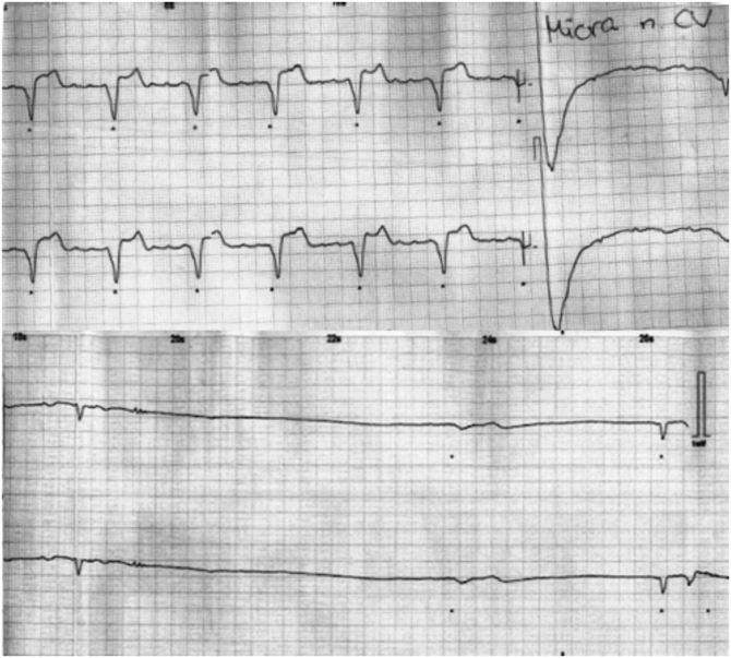 Transient Dysfunction Of Leadless Pacemaker System After Cardioversion 