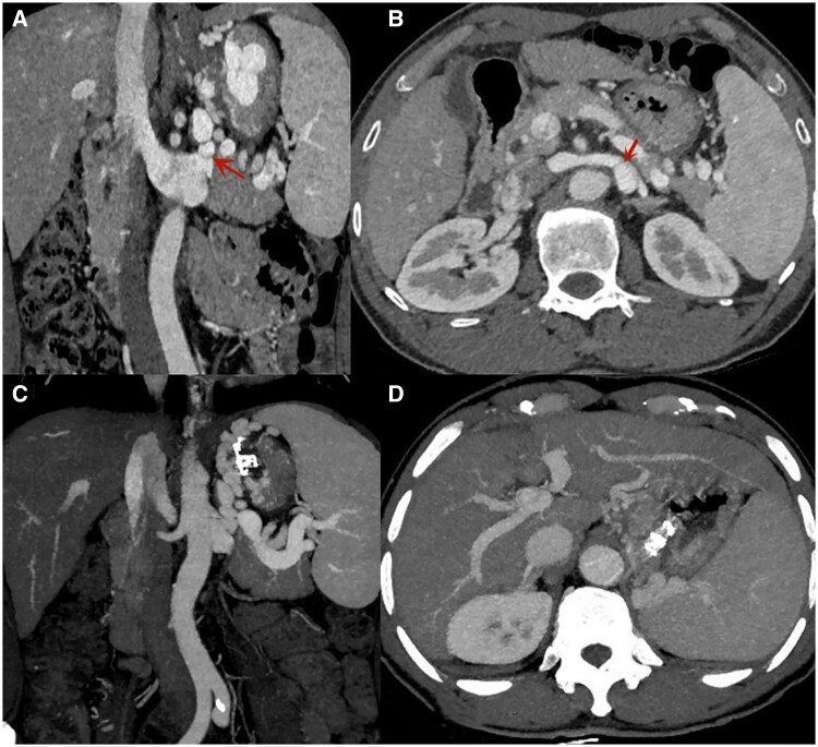 Efficacy and safety of EUS-guided coil embolization in combination with ...