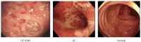 The image displays three different types of gastrointestinal inflammation: UC+CMV, UC, and normal.