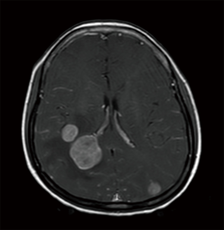 radiotherapy-of-brain-metastasis-from-lung-cancer-in-limited-resource