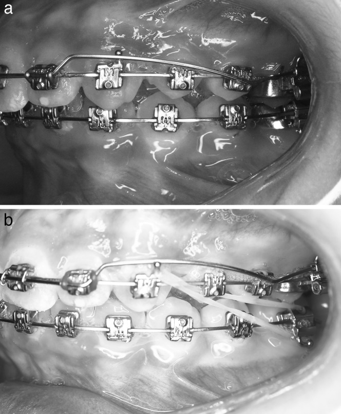 Figure 2. (a) Intraoral photographs at that start of study intervention (T1). (b) Photographs after completion of molar tip-back (T2).