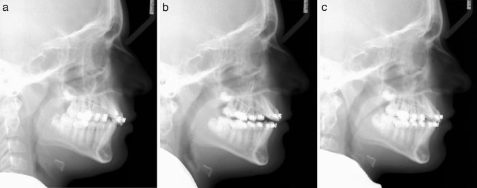 Figure 3. (a–c) Lateral cephalometric radiographs before molar tip-back (T1), after molar tip-back (T2), and after molar uprighting (T3).