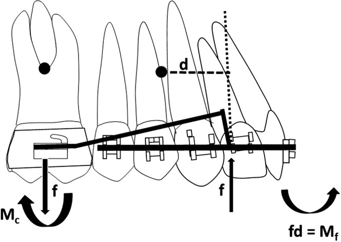 Figure 1. The intrusion arch exerts an intrusive force (f) on the anterior segment, extrusive force on the molar and clockwise moment of a couple (Mc). Counterclockwise moment of a force (Mf) is generated on the anterior anchorage unit as the intrusive force was anterior to the center of resistance of the anchorage unit.