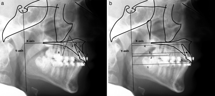 Figure 4. Occlusal view of bonded maxillary expander.