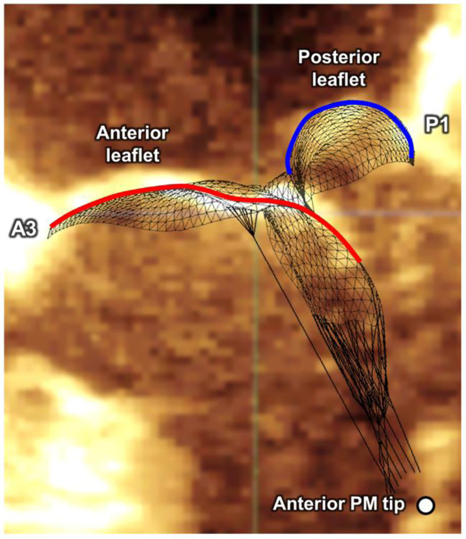 Mitral Valve Repair Using ePTFE Sutures for Ruptured Mitral Chordae ...