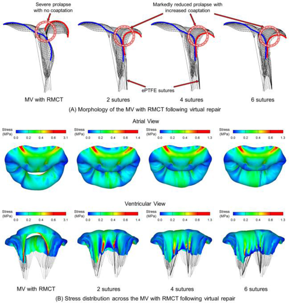 Mitral Valve Repair Using ePTFE Sutures for Ruptured Mitral Chordae ...