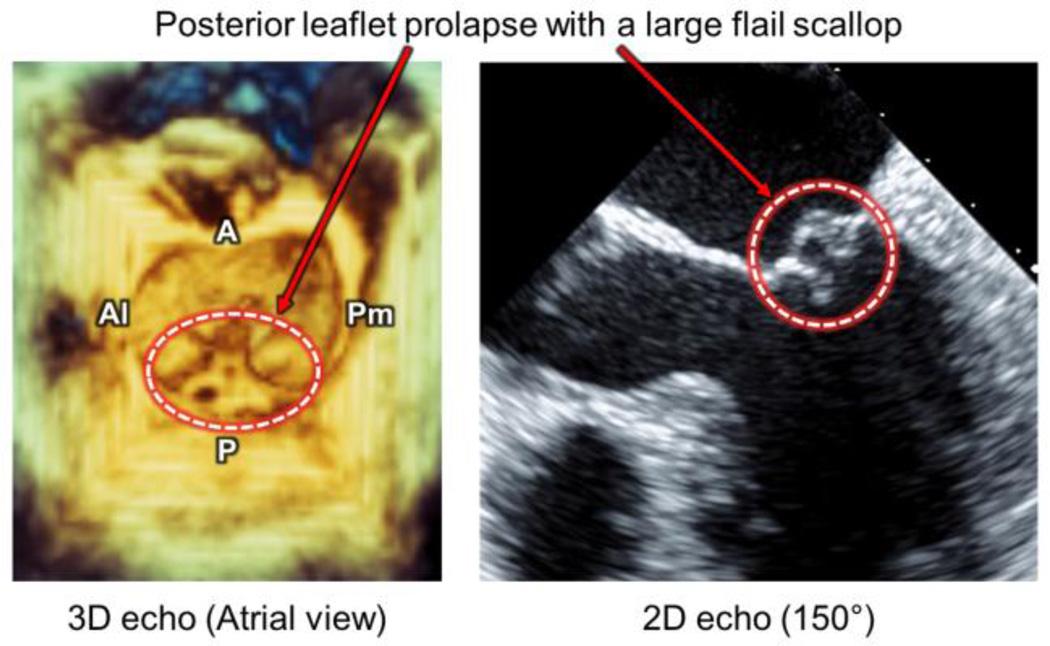 Mitral Valve Repair Using ePTFE Sutures for Ruptured Mitral Chordae ...