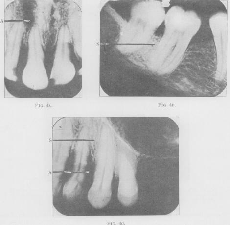 Figs. 4A, B and C