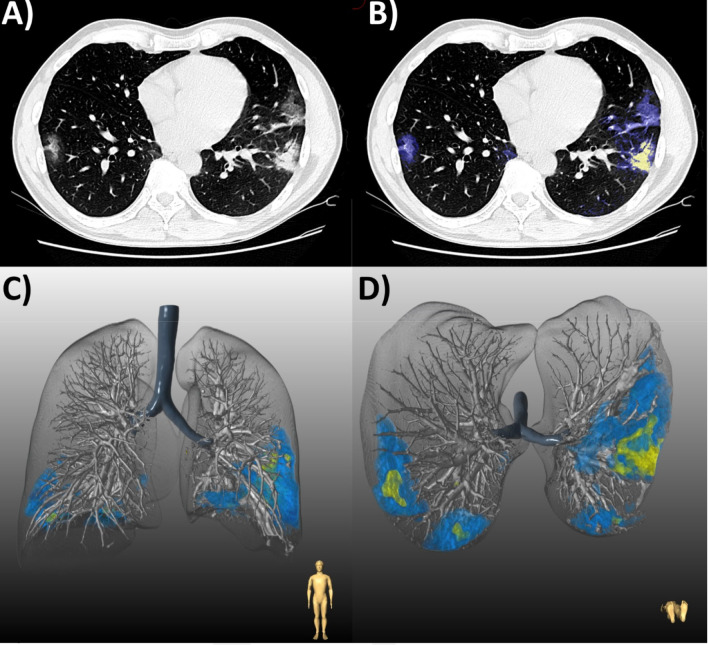 (a) Chest CT of a 48-year-old man with COVID-19 pneumonia who was discharged following an uncomplicated 6-day hospital admission. (b) Axial slice demonstrates bilateral peripheral ground glass opacities (GGO, blue) with patchy consolidation (yellow). Lesion quantification revealed a GGO burden of 5.1% and consolidation burden of 0.7%. Three-dimensional lung renderings depict the distribution of disease in (c) coronal and (d) axial planes.