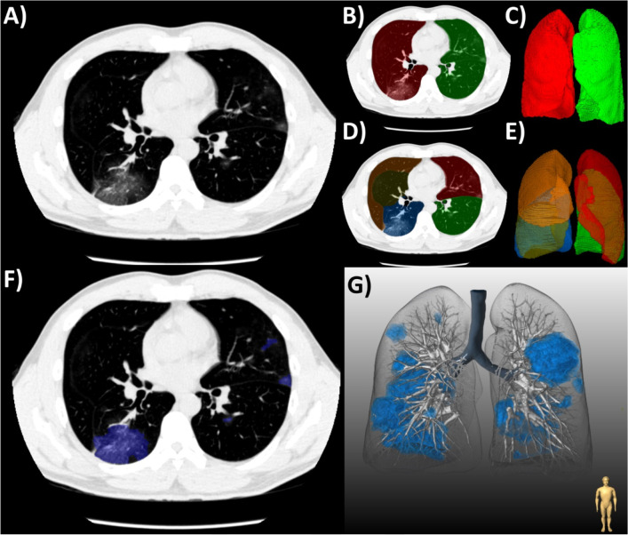 (a) Workflow for the quantification of COVID-19 pneumonia on chest CT in a patient with typical ground-glass opacities. (b-c) First, both lungs and (d-e) their respective lobes were automatically segmented by a deep-learning algorithm. Second, semi-automated segmentation of lesions was performed using (f) axial slices and shown with (g) three-dimensional rendering.