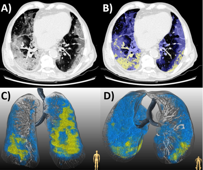 (a) Chest CT of an 87-year-old man with COVID-19 pneumonia who died 10 days later. (b) Axial slice shows bilateral diffuse ground glass opacities (GGO, blue) and consolidation (yellow). Lesion quantification revealed a GGO burden of 44.0% and consolidation burden of 8.0%. Three-dimensional renderings depict the distribution of disease in (c) coronal and (d) axial planes.