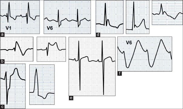 ST-segment elevation myocardial infarction mimics: The differential ...