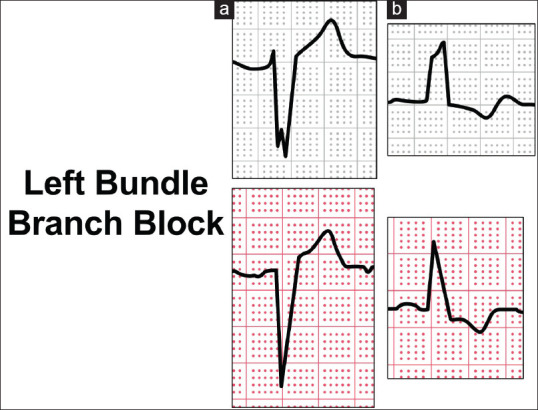 ST-segment elevation myocardial infarction mimics: The differential ...