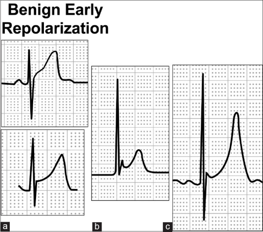 ST-segment elevation myocardial infarction mimics: The differential ...