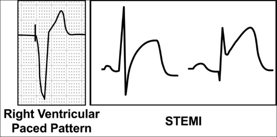 ST-segment elevation myocardial infarction mimics: The differential ...