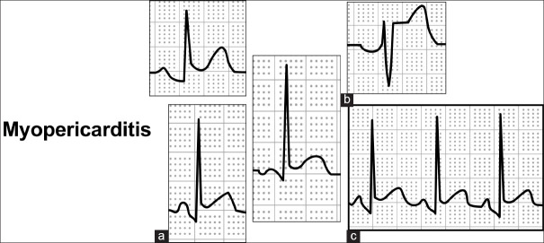 ST-segment elevation myocardial infarction mimics: The differential ...