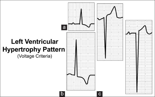 ST-segment elevation myocardial infarction mimics: The differential ...