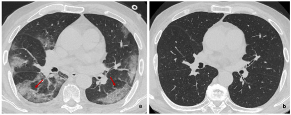 (a) Baseline and (b) six-month follow-up axial thin-section unenhanced Chest CT scans of 83-year-old man, former smokers, who presented fever, cough and worsening dyspnea; COVID-19 was confirmed by reverse transcription polymerase chain reaction (RT-PCR) testing. (a) Baseline scan shows multiple bilateral and confluent ground-glass opacities with predominantly linear pattern and peripheral distribution (red arrows). (b) Six-month follow-up scan shows complete resolution of ground-glass opacities without fibrotic-like changes.