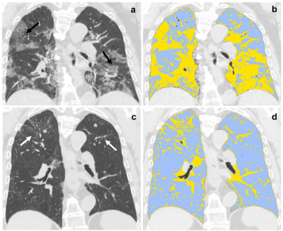 (a,b) Baseline and (c,d) six-month follow-up coronal thin-section unenhanced Chest CT scans of 79-year-old man, admitted to the Emergency Department presenting fever, dyspnea and cough; COVID-19 was confirmed by reverse transcription polymerase chain reaction (RT-PCR) testing. (a) Chest CT scan shows bilateral ground-glass opacities tending to consolidation (black arrow). (b) The same scan after Quantitative Chest CT Analysis highlighted in light-blue well-aerated lung (1.5 liters, 50%) and in yellow pulmonary injury of COVID-19 pneumonia. (c) Six-month follow-up scan shows residual fibrotic-like changes (white arrows) and persisting of low-density ground glass (asterisks). (d) The same scan after Quantitative Chest CT Analysis highlighted in light-blue well-aerated lung (3.5 liters, 82%) and in yellow residual findings of COVID-19 pneumonia at six months follow-up.