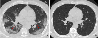 (a) Baseline and (b) six-month follow-up axial thin-section unenhanced
Chest CT scans of 83-year-old man, former smokers, who presented fever,
cough and worsening dyspnea; COVID-19 was confirmed by reverse transcription
polymerase chain reaction (RT-PCR) testing. (a) Baseline scan shows multiple
bilateral and confluent ground-glass opacities with predominantly linear
pattern and peripheral distribution (red arrows). (b) Six-month follow-up
scan shows complete resolution of ground-glass opacities without
fibrotic-like changes. 