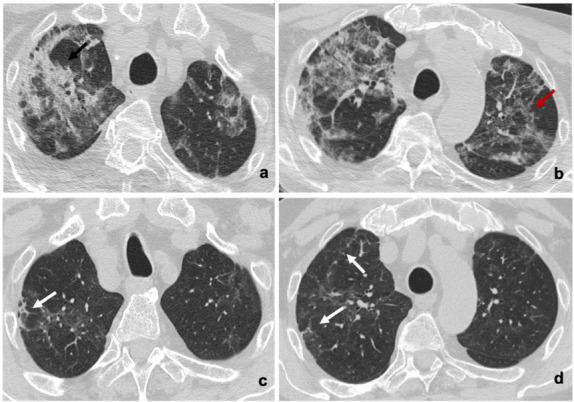 (a,b) Baseline and (c,d) six-month follow-up axial thin-section unenhanced Chest CT scans of 84-year-old man, smoker, admitted to the Emergency Department presenting fever and cough; COVID-19 was confirmed by reverse transcription polymerase chain reaction (RT-PCR) testing. (a,b) Images show bilateral consolidative pulmonary opacities (black arrow) with diffuse ground-glass opacities and interstitial septal thickening (red arrow). (c,d) Six-month follow-up scans show residual ground-glass opacities with decreased density compared to baseline, interstitial septal thickening and peripheral fibrotic-like changes (white arrows).