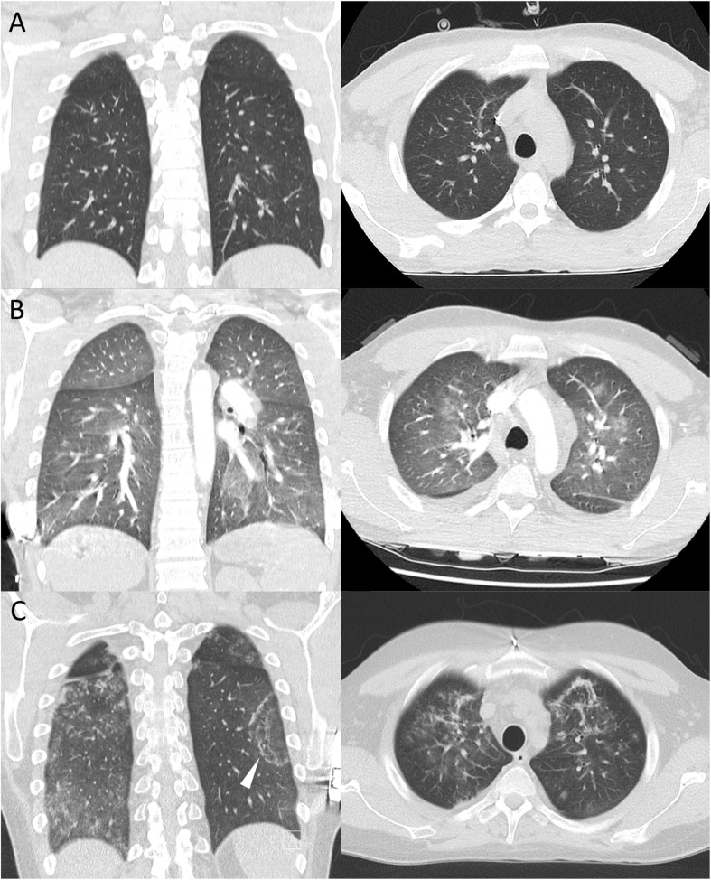 Covid-19 In A Severely Immunosuppressed Patient With Life-threatening 