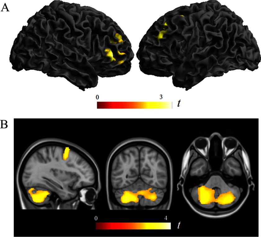 Figure 1A is a 3D rendering of gray matter clusters in the right and left prefrontal and left promotor cortices associated with lifelong greenness exposure. Figure 1B is an orthogonal display of the brain including white matter clusters in cerebellum and left premotor regions associated with lifelong greenness exposure.